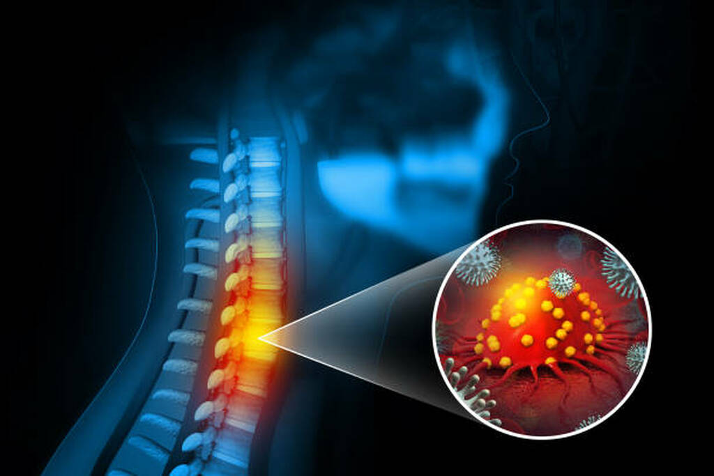 Best Spinal Cord Tumour Treatment In Mumbai